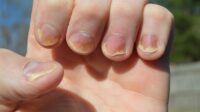 Ilustrasi. Ada beberapa tanda masalah kesehatan dari kuku [foto:dok/klikdokter]