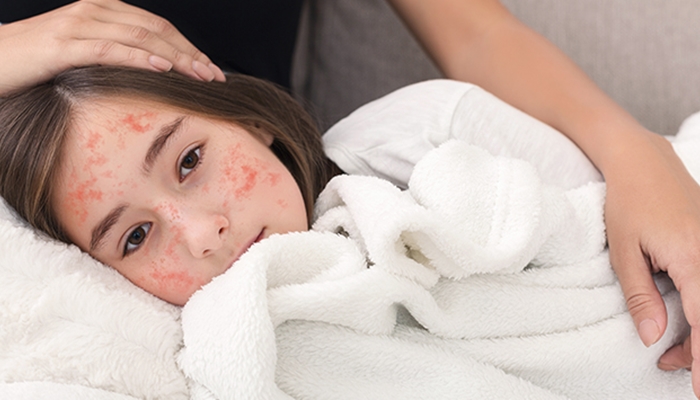 Ilustrasi. Amnesia imun jadi salah satu masalah kesehatan yang bisa muncul akibat campak [foto:dok/halodoc]