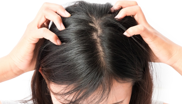 Ilustrasi. Faktanya bahwa kehadiran kutu di rambut lebih dipengaruhi oleh kebiasaan sehari-hari yang tanpa disadari [foto:dok/alodoc]